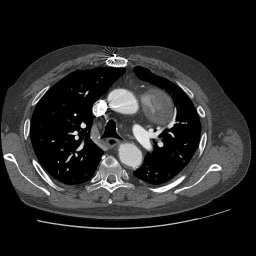 File:Aorto-coronary bypass graft aneurysms (Radiopaedia 40562-43157 A 40).png