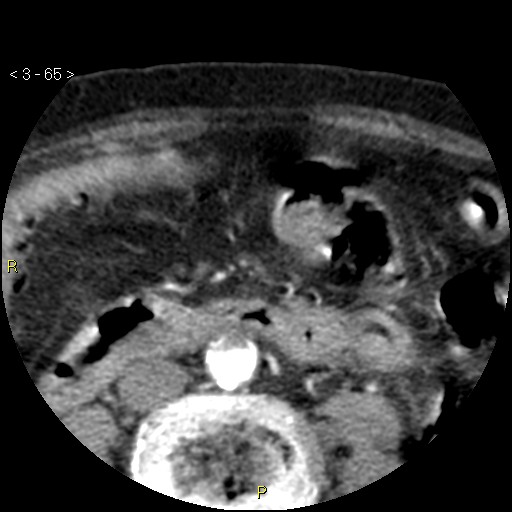 Aortoiliac occlusive disease (Radiopaedia 16828-16548 A 65).jpg