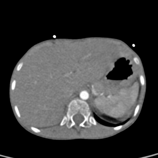 File:Aortopulmonary window, interrupted aortic arch and large PDA giving the descending aorta (Radiopaedia 35573-37074 B 91).jpg