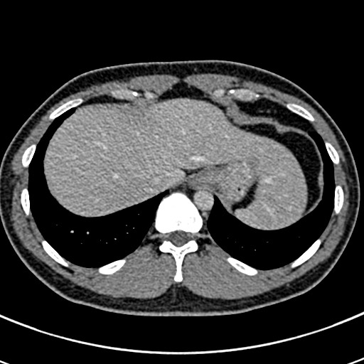 Apical lung mass mimic - neurogenic tumor (Radiopaedia 59918-67521 A 71).jpg