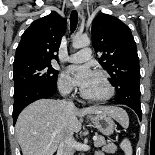 File:Apical lung mass mimic - neurogenic tumor (Radiopaedia 59918-67521 B 60).jpg