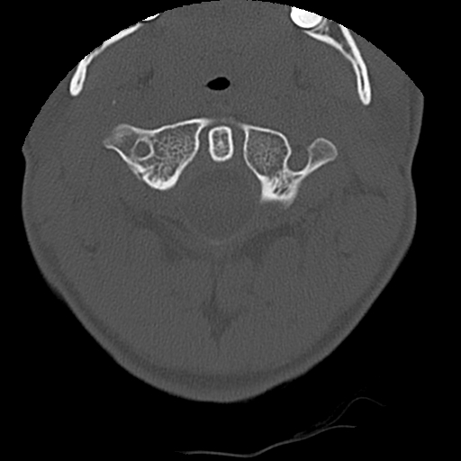 Apical pneumothorax on cervical spine CT (Radiopaedia 45343-49368 Axial bone window 14).jpg