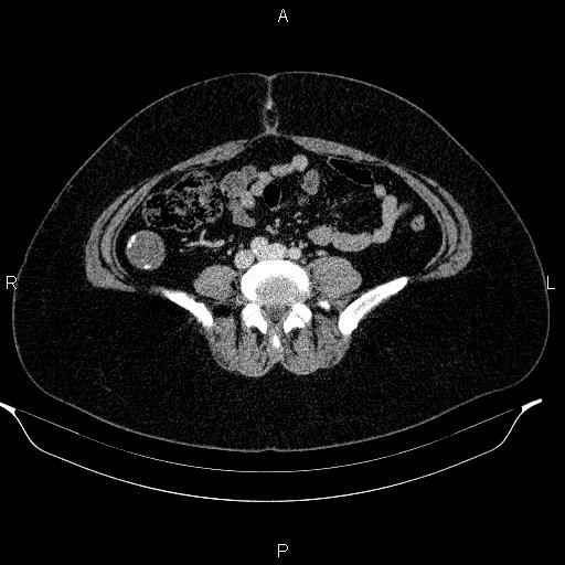 Appendiceal mucocele (Radiopaedia 83280-97688 Axial With contrast 68).jpg