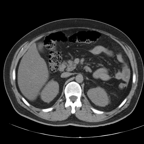 File:Appendicitis and giant appendicolith (Radiopaedia 80251-93588 Axial non-contrast 17).jpg