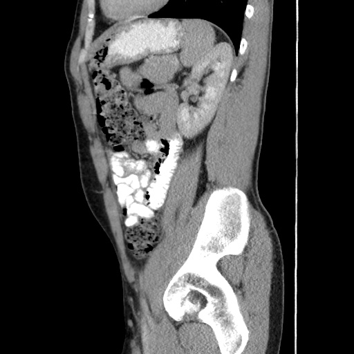 Appendicitis complicated by post-operative collection (Radiopaedia 35595-37114 C 51).jpg