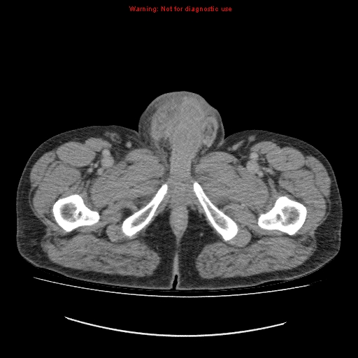 File:Appendicitis mass in inguinal hernia (Radiopaedia 26858-27029 A 40).jpg