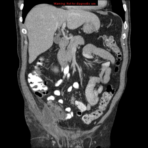 File:Appendicitis mass in inguinal hernia (Radiopaedia 26858-27029 B 23).jpg