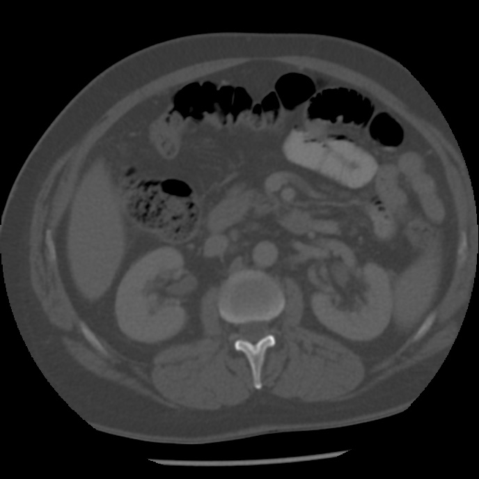 Appendicitis with perforation (Radiopaedia 35790-37342 Axial bone window 21).jpg