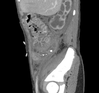 File:Appendicitis with phlegmon (Radiopaedia 9358-10046 E 1).jpg