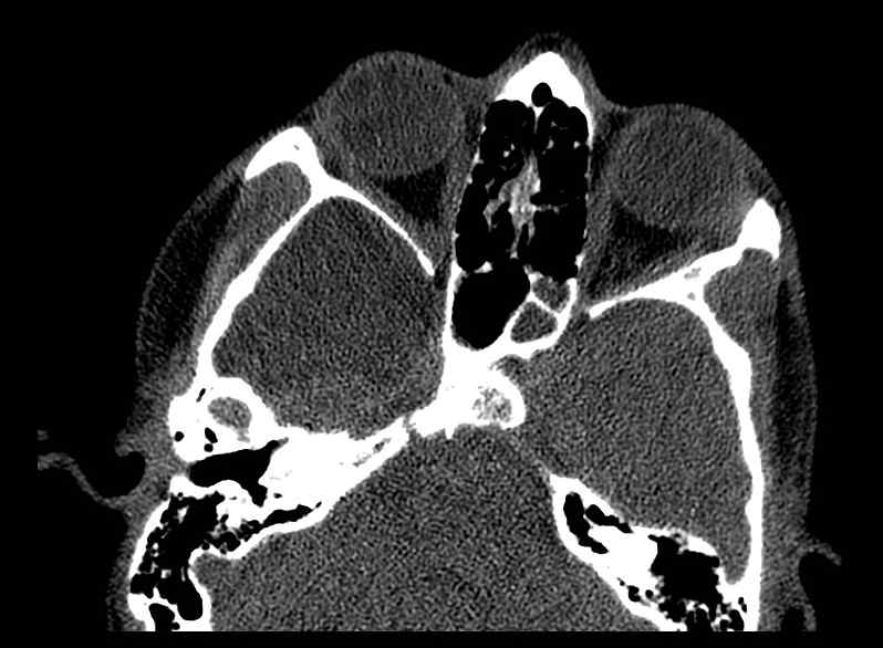 Arachnoid cyst- extremely large (Radiopaedia 68741-78450 Axial bone window 19).jpg