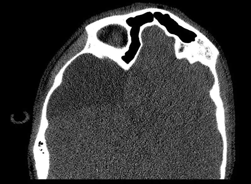 Arachnoid cyst- extremely large (Radiopaedia 68741-78450 Axial bone window 39).jpg
