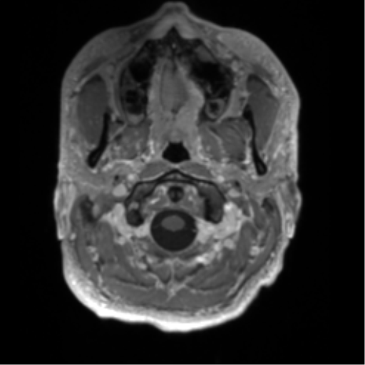 Arachnoid cyst with subdural hematoma (Radiopaedia 85892-101743 Axial T1 C+ 6).png