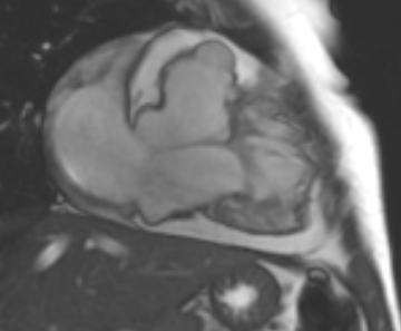 File:Arrhythmogenic right ventricular cardiomyopathy (Radiopaedia 69431-79307 2ch cine 48).jpg