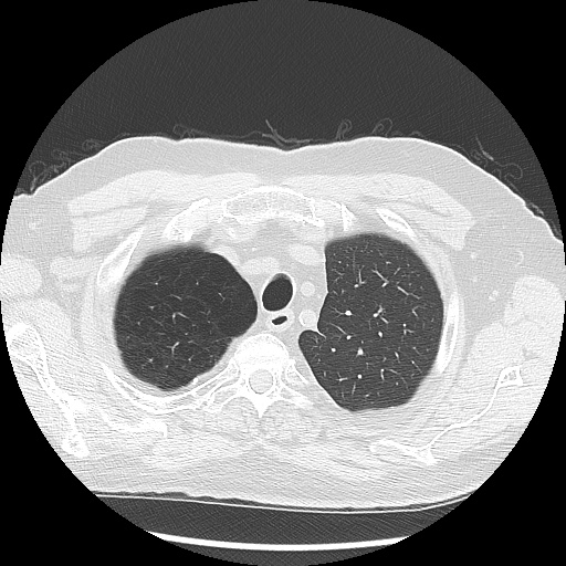 Asbestos-related pleural disease (Radiopaedia 74366-85250 Axial lung window 22).jpg