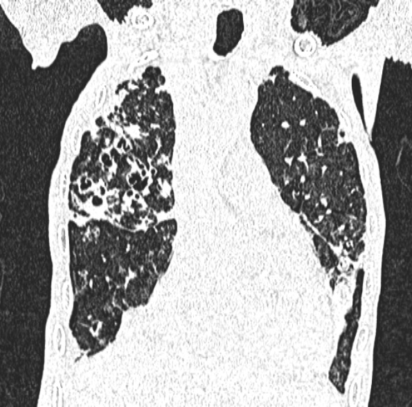 Aspergilloma- with Monod sign (Radiopaedia 44737-48532 Coronal lung window 194).jpg