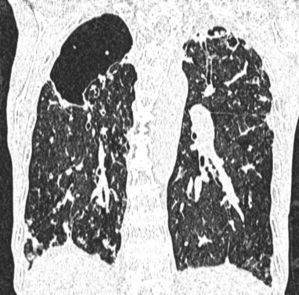 Aspergilloma- with Monod sign (Radiopaedia 44737-48532 Coronal lung window 311).jpg