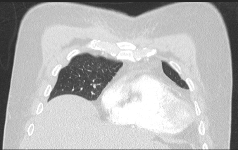 Aspirated tooth (Radiopaedia 28584-28844 Axial lung window 34).jpg