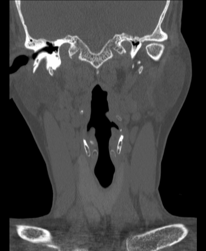Atlanto-occipital assimilation with basilar invagination (Radiopaedia 70122-80188 Coronal bone window 26).jpg