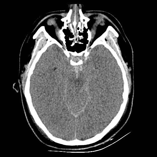 File:Atlanto-occipital dislocation (Radiopaedia 44648-48412 Axial non-contrast 21).jpg
