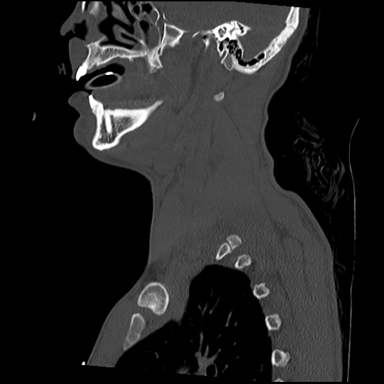 File:Atlanto-occipital dissociation (Traynelis type 1), C2 teardrop fracture, C6-7 facet joint dislocation (Radiopaedia 87655-104061 Sagittal bone window 17).jpg