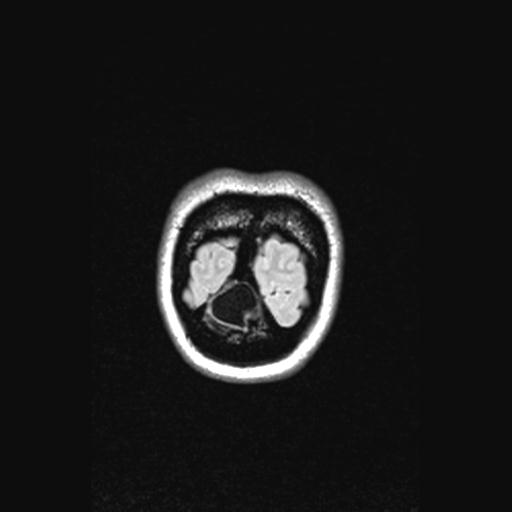 Atretic encephalocoele with inferior vermis hypoplasia (Radiopaedia 30443-31108 Coronal FLAIR 17).jpg