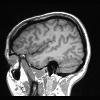 Atretic encephalocoele with inferior vermis hypoplasia (Radiopaedia 30443-31108 Sagittal T1 106).jpg