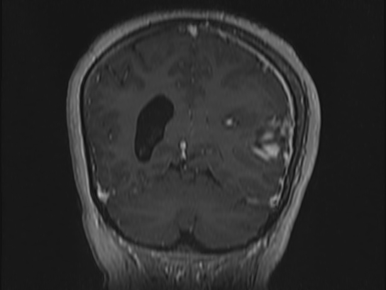 Atypical meningioma (Radiopaedia 62985-71406 Coronal T1 C+ 95).jpg
