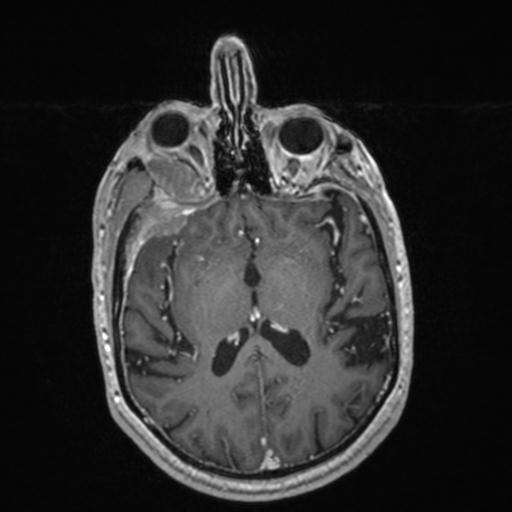 Atypical meningioma (grade II) - en plaque (Radiopaedia 29633-30147 Axial T1 C+ 100).jpg