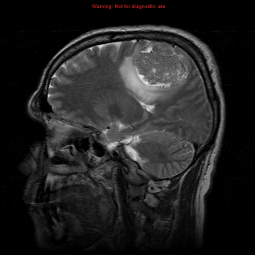 File:Atypical meningioma - grade II (Radiopaedia 13303-13305 Sagittal T2 9).jpg