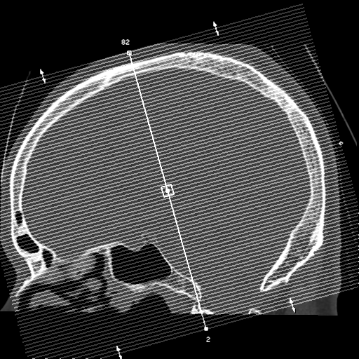 Atypical meningioma with skull invasion (Radiopaedia 34357-35649 Axial bone window 1).png