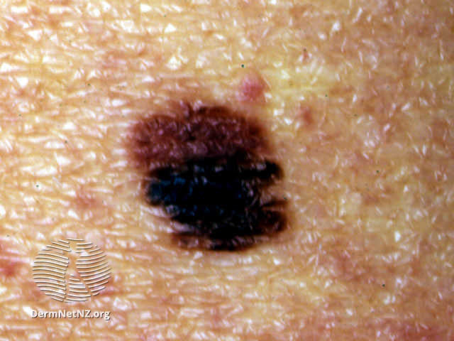 File:Atypical naevus (DermNet NZ doctors-lesions-images-bml-a3).jpg