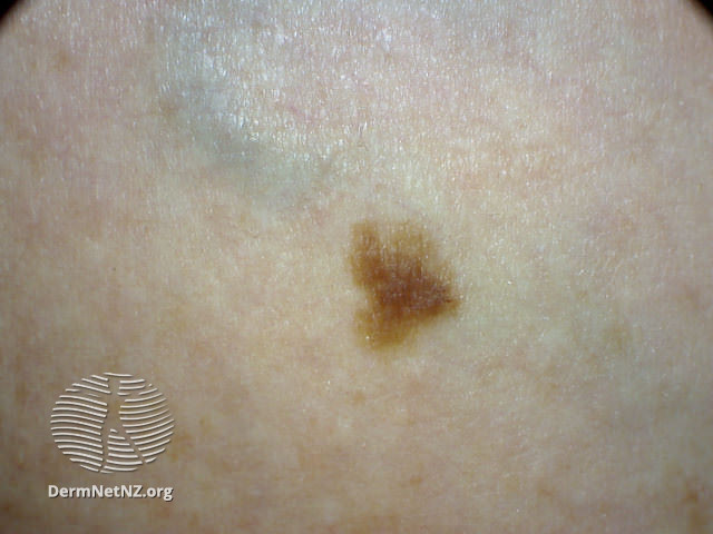 File:Atypical naevus (DermNet NZ lesions-atypical-naevi-585).jpg