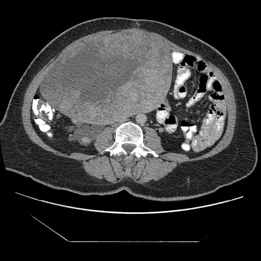 File:Atypical retroperitoneal lymphocoeles with large leiomyoma of uterus (Radiopaedia 32084-33024 A 22).jpg