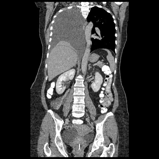 File:Atypical retroperitoneal lymphocoeles with large leiomyoma of uterus (Radiopaedia 32084-33024 B 14).jpg