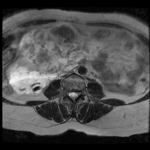 File:Atypical retroperitoneal lymphocoeles with large leiomyoma of uterus (Radiopaedia 32084-33027 Axial T2 4).jpg