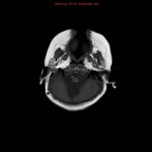 File:Atypical teratoid rhabdoid tumor (Radiopaedia 10712-11183 Axial T1 16).jpg