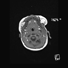 Atypical teratoid rhabdoid tumor (prenatal US and neonatal MRI) (Radiopaedia 59091-66388 Axial T1 6).jpg
