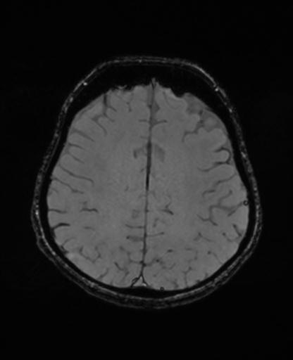 Autoimmune limbic encephalitis (Radiopaedia 30363-31005 SWI - magnitude 56).jpg