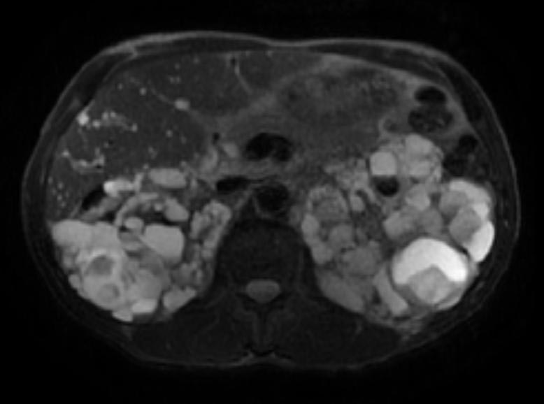File:Autosomal dominant polycystic kidney disease (Radiopaedia 11220-11585 B 1).jpg