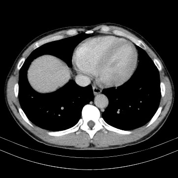 Autosomal dominant polycystic kidney disease (Radiopaedia 66349-75582 B 3).jpg