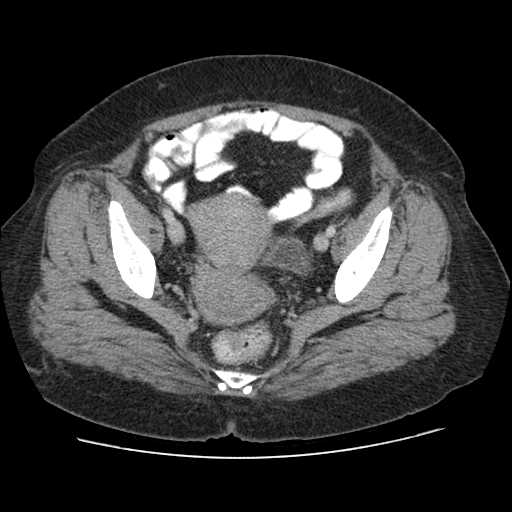 File:Autosomal dominant polycystic kidney disease with hepatic involvement (Radiopaedia 32693-33662 B 71).jpg