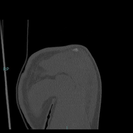 Avascular necrosis after fracture dislocations of the proximal humerus (Radiopaedia 88078-104655 Coronal bone window 40).jpg