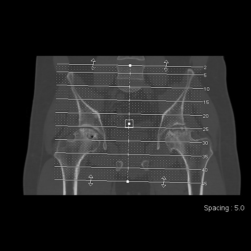 File:Avascular necrosis of the hip (Radiopaedia 61503-69467 Axial bone window 1).jpg