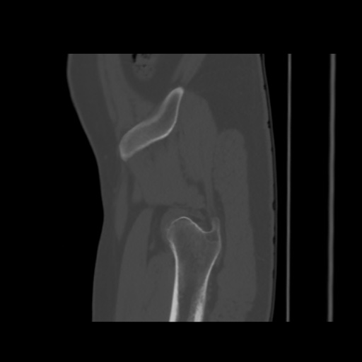 Avascular necrosis of the hip (Radiopaedia 61503-69467 B 7).jpg