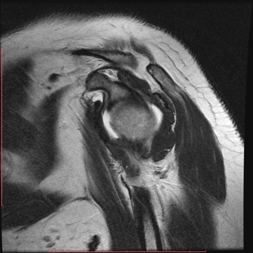 File:Avulsion fracture - greater tuberosity of humerus (Radiopaedia 25457-25703 Sagittal T2 4).jpg