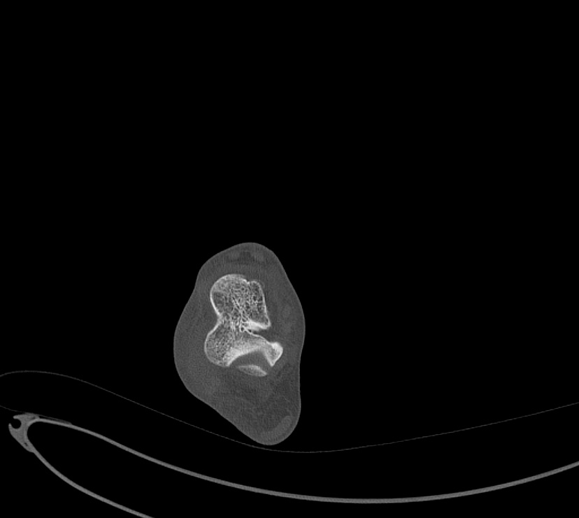 Avulsion fractures of talus and calcaneus (Radiopaedia 48277-53155 Axial bone window 33).jpg