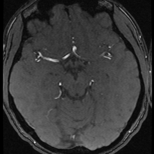 Azygos anterior cerebral artery (Radiopaedia 17059-16756 Axial MRA 38).jpg