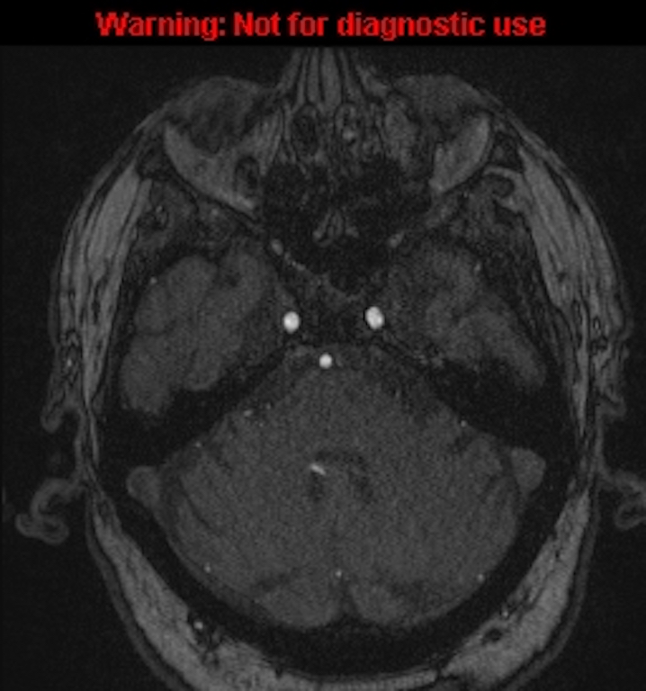 Azygos anterior cerebral artery (Radiopaedia 59325-66677 Axial MRA 39).jpg