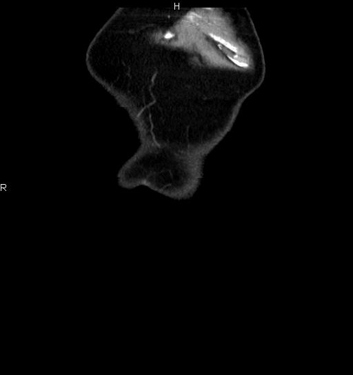 Azygos continuation of the inferior vena cava (Radiopaedia 18537-18404 D 7).jpg