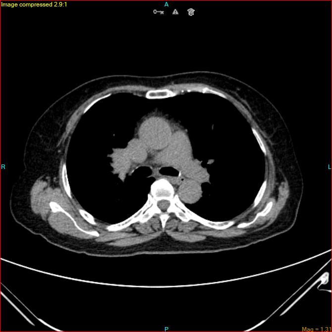 Azygos vein aneurysm (Radiopaedia 77824-90130 A 27).jpg